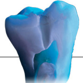 material dental de cerámica