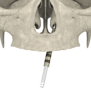broca de implantología dental 1