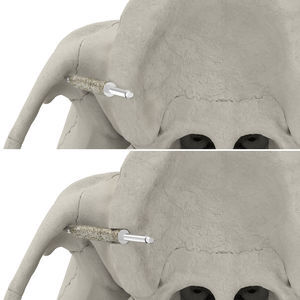 broca para osteotomía de implantes 1