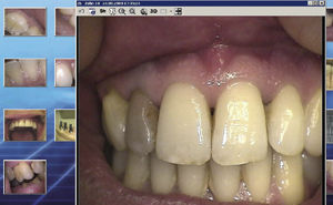 cámara de vídeo intraoral