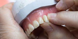 prótesis dental de composite