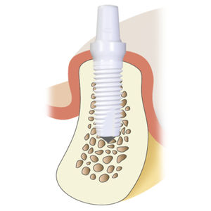 implante dental cilíndrico