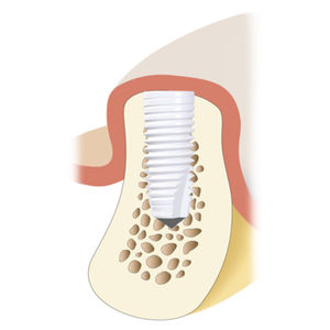 implante dental cilíndrico