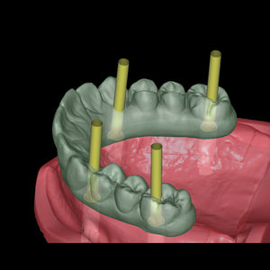 módulo de software de implantología dental