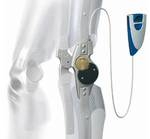 prótesis externa de rodilla con bloqueo manual