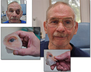 prótesis estética esterna hemifacial