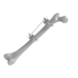 fijador externo para fémur 1