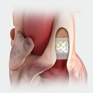 bioprótesis valvular pulmonar