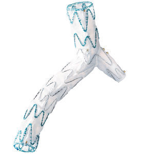 stent-injerto arteria ilíaca