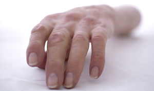 prótesis estética esterna para brazo 1