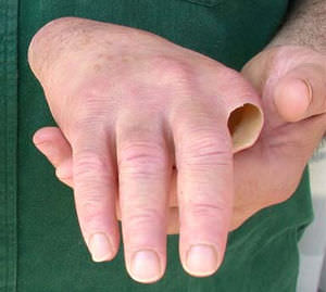 prótesis estética esterna de mano