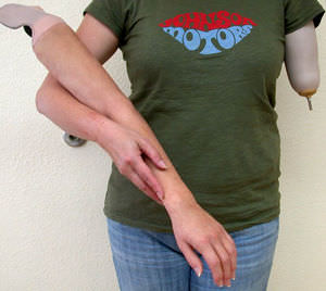 prótesis estética esterna para brazo
