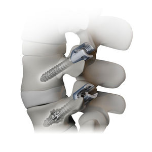 tornillo pedicular para vértebra torácica, lumbar