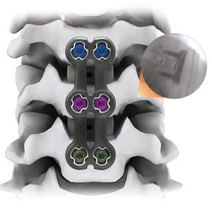 placa de artrodesis para vértebra cervical 1