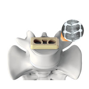 caja intersomática lumbar 1