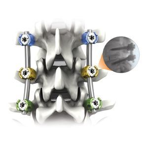 sistema de osteosíntesis toracolumbar 1