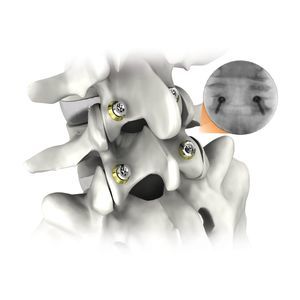 sistema de osteosíntesis toracolumbar 1