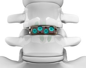 caja intersomática lumbar 1