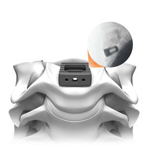 caja intersomática cervical 1