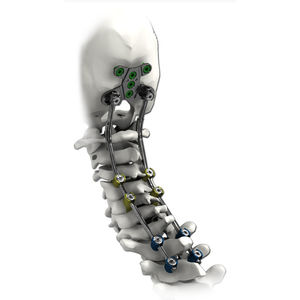 sistema de osteosíntesis occipitocervicotorácico