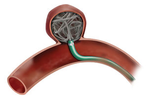 espiral de embolización