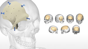 implante craneal a medida
