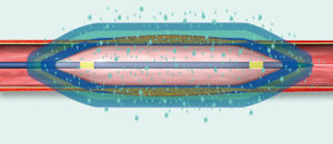 catéter ATP