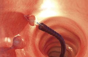 cesta endoscopica para la extracción de pólipos intestinales