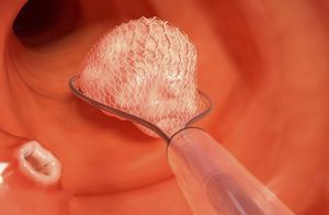 pinza para endoscopia