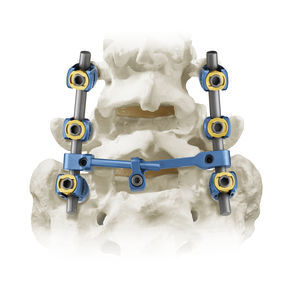 tornillo pedicular para vértebra torácica, lumbar