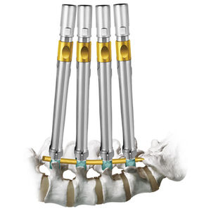 sistema de posicionamiento de tornillos pediculares mínimamente invasivo 1
