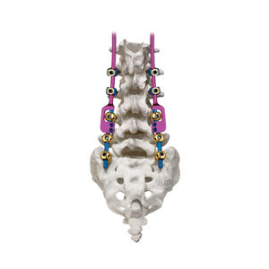 sistema de osteosíntesis toraco-lumbo-sacro 1