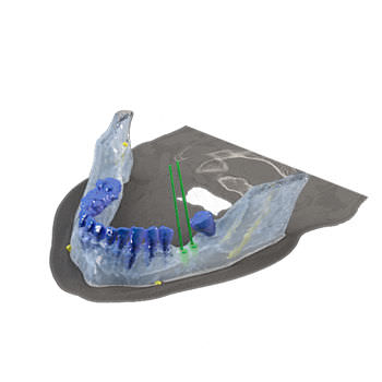 Software de implantología dental - Reconstruction 3D - Drive Dental Implants - de simulación de implante dental / de visualización 3D / de modelado