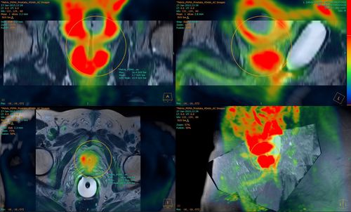 Software de análisis - Fusion Technology™ - Hermes Medical Solutions, Inc - de visualización 3D / para informes / con sistema de seguimiento