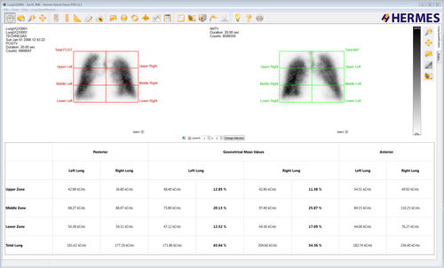 Software de análisis - Lung Lobe Quantification™ - Hermes Medical Solutions, Inc - de diagnóstico / de planificación / de evaluación