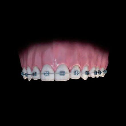 Módulo de software de creación de prótesis dentales - BlueSkyBio - para ortodoncia