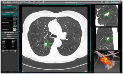 Software de análisis - MeVis Medical Solutions AG - de CAD / de evaluación / para cuantificación