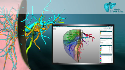 Software de análisis de imágenes - LiverSuite - MeVis Medical Solutions AG - de visualización / de planificación de tratamiento / para la importación de imágenes médicas