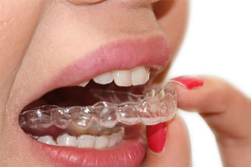Aparato miofuncional - Smilers  - BIOTECH DENTAL