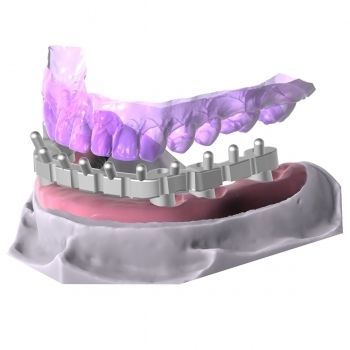 Módulo de software de diseño - 4208 - Champions Implants GmbH - de creación de prótesis dentales / de CAD / FAO