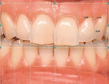 Módulo de software para odontología - 4218 - Champions Implants GmbH - de diseño / de CAD / de diseño digital de la sonrisa