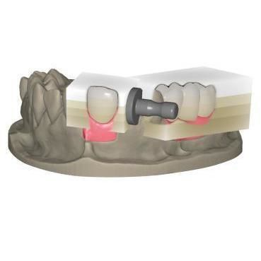 Módulo de software para restauración dental - In-Cad Nesting - Champions Implants GmbH - de diseño / de fabricación / de dientes
