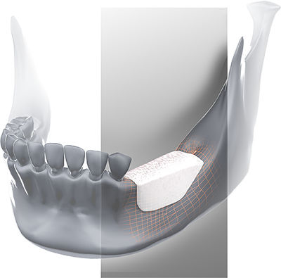 Sustituto óseo alotrasplante - Global D - para cirugía dental / rígido