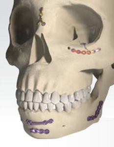 Placa de compresión para macizo facial - ORTRAUTEK  - Global D - metálica