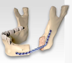 Placa de osteotomía para mandíbula - CARCITEK  - Global D - bloqueada / metálica