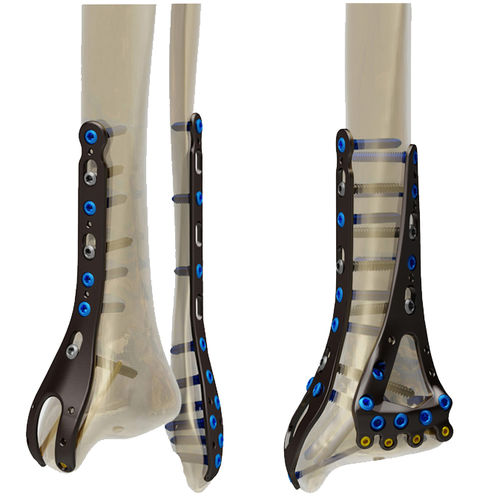 Placa de compresión para peroné -  STEP® - Response Ortho - para tibia / porción distal / no bloqueada