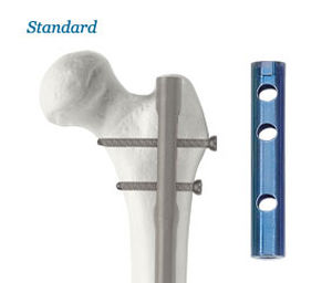 Clavo intramedular para fémur - AOS - Advanced Orthopaedic Solutions