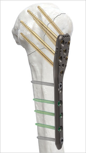 Placa de compresión para húmero - AOS - Advanced Orthopaedic Solutions - porción proximal / bloqueada / metálica