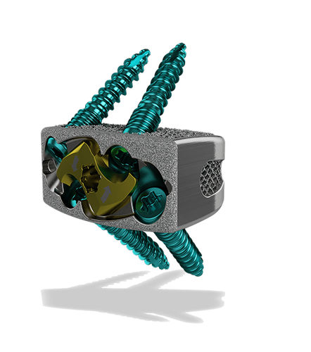 Caja intersomática lumbar - Harrier® SA - ChoiceSpine - vía anterior / de titanio / impresa en 3D