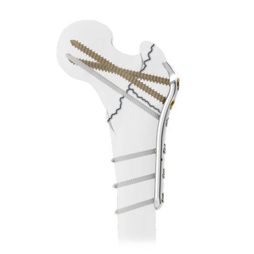 Placa de compresión para fémur - PFF  - Intrauma - para trocánter / porción proximal / porción medial